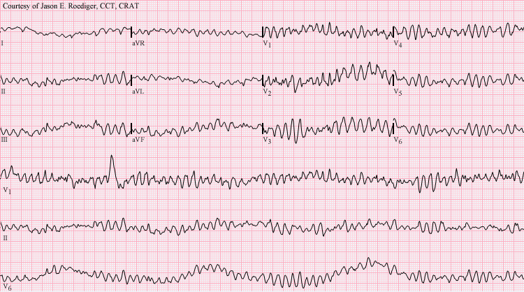 Ventricular_fibrillation